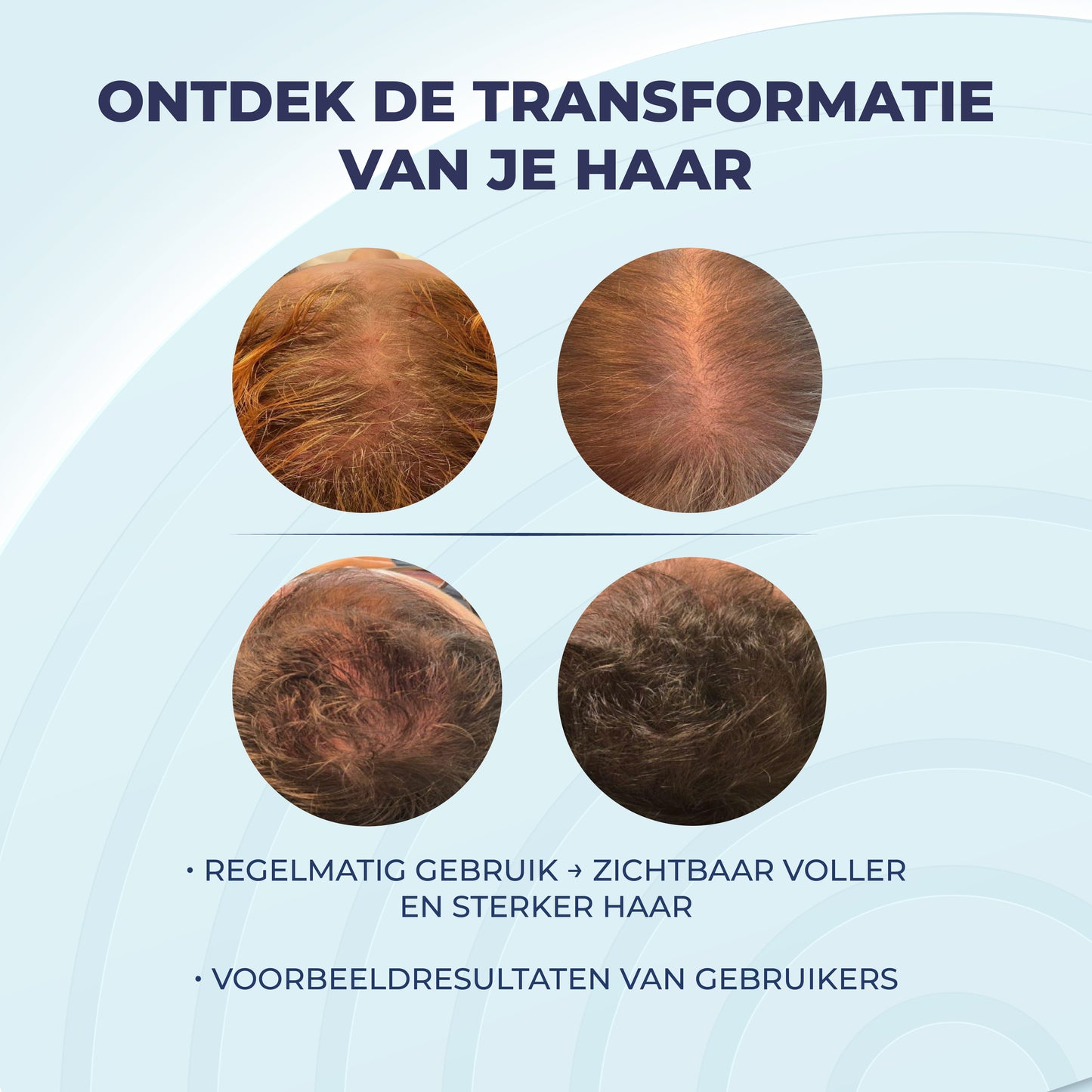 Minoxidil 5% Spray met 1% DHT Blocker & Castor Oil โ Voor Sterker, Voller en Gezonder Haar