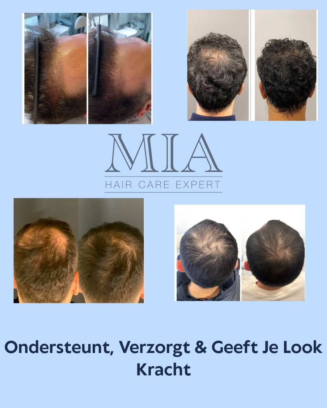 5% Minoxidil Spray met Caffeïne, Biotine & Panthenol